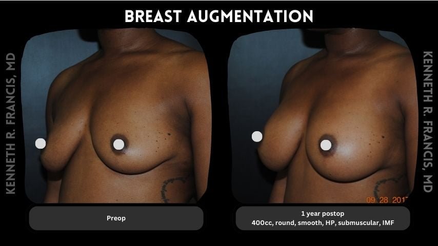 Breast augmentation before and after 6 Breast augmentation 10