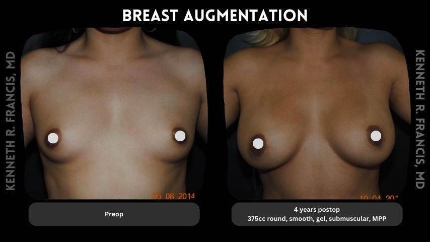 Breast augmentation before and after 12 Breast augmentation 5
