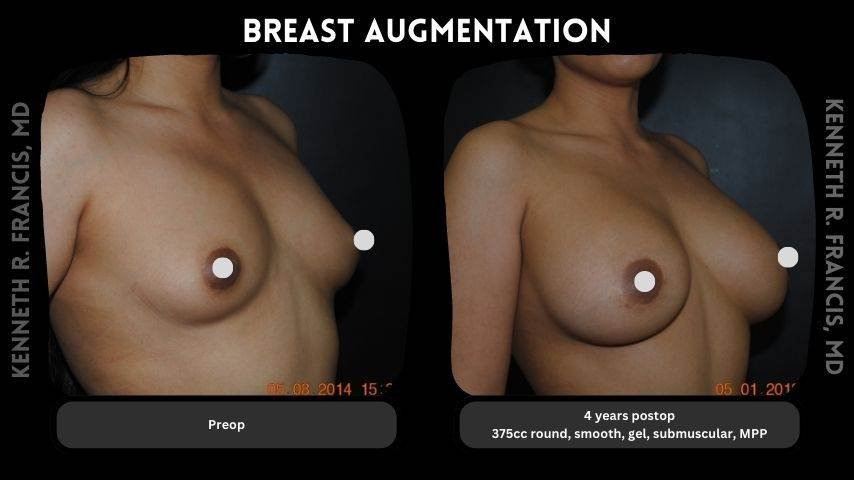 Breast augmentation before and after 10 Breast augmentation 6