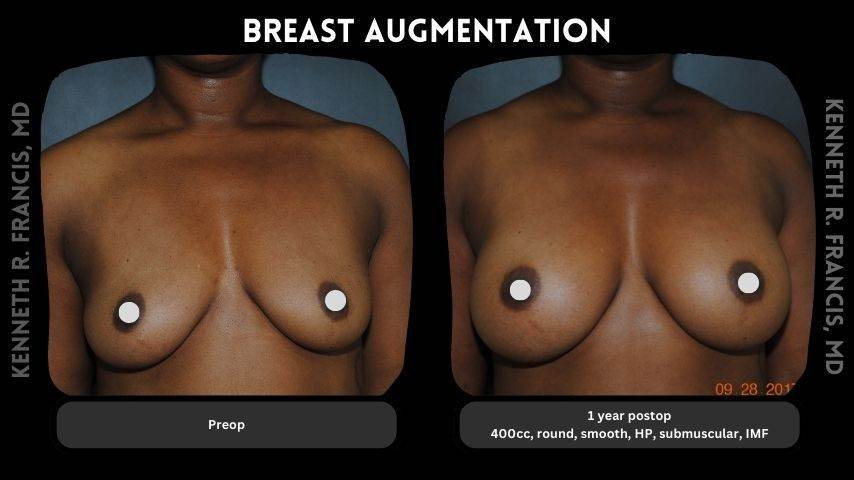 Breast augmentation before and after 9 Breast augmentation 7