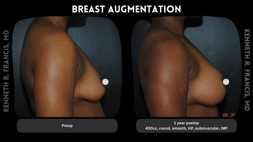 Breast augmentation before and after 8 Breast augmentation 8