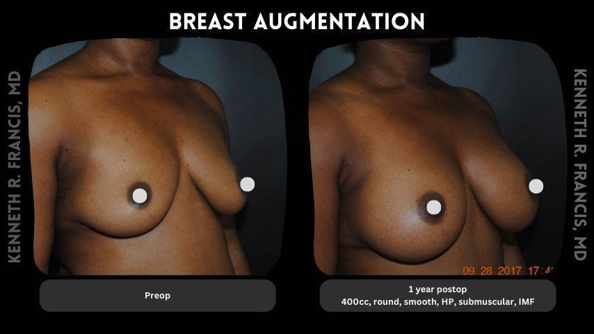 Breast augmentation before and after 7 Breast augmentation 9