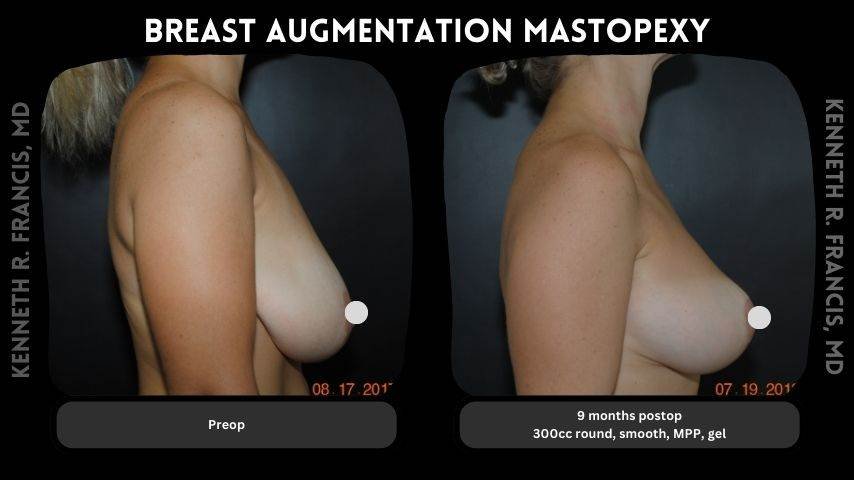 Breast augmentation before and after 13 Breast augmentation mastopexy 1