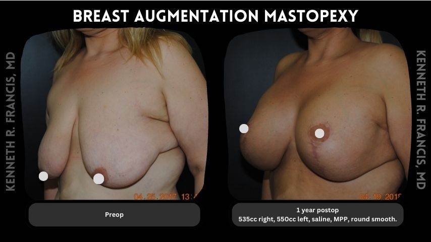 Breast augmentation before and after 14 Breast augmentation mastopexy 2