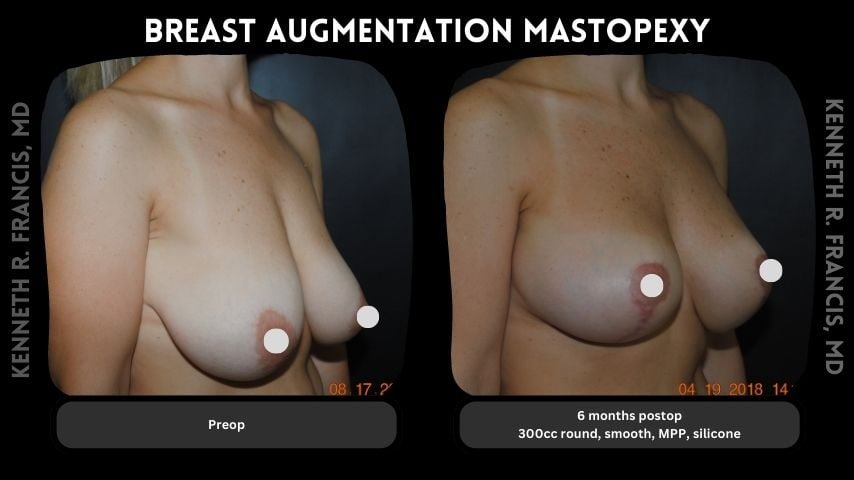 Breast augmentation before and after 15 Breast augmentation mastopexy 3
