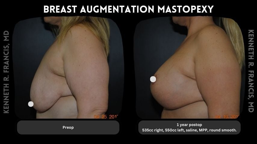 Breast augmentation before and after 16 Breast augmentation mastopexy 4