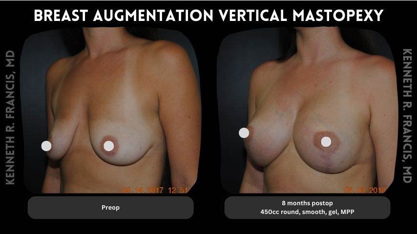 Breast augmentation before and after 17 Breast augmentation vertical mastopexy 1