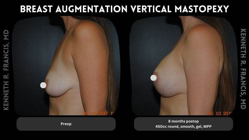 Breast augmentation before and after 18 Breast augmentation vertical mastopexy 2