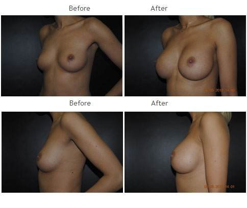 Breast augmentation before and after 28 Breast Augmentation NYC Case 1046
