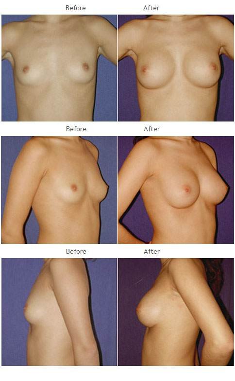 Breast augmentation before and after 29 Breast Augmentation NYC Case 1047