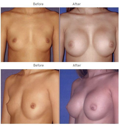 Breast augmentation before and after 31 Breast Augmentation NYC Case 1049