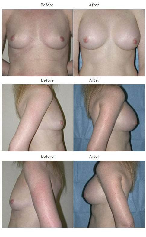 Breast augmentation before and after 32 Breast Augmentation NYC Case 1050