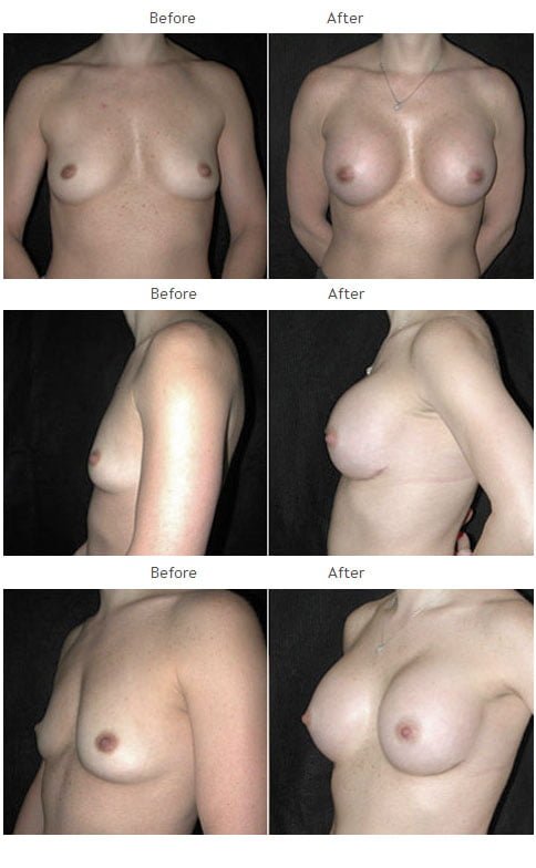 Breast augmentation before and after 33 Breast Augmentation NYC Case 1051