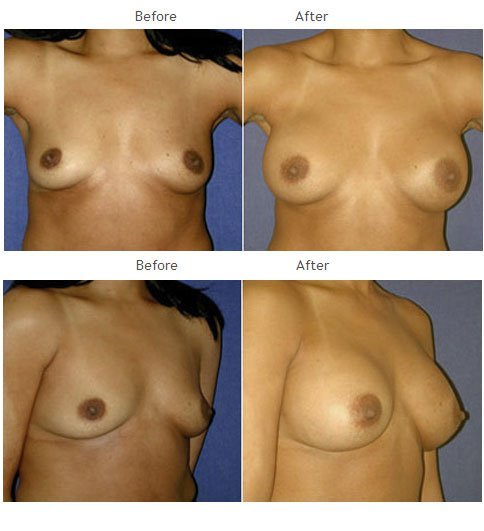 Breast augmentation before and after 34 Breast Augmentation NYC Case 1052