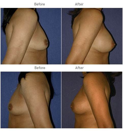 Breast augmentation before and after 35 Breast Augmentation NYC Case 1053