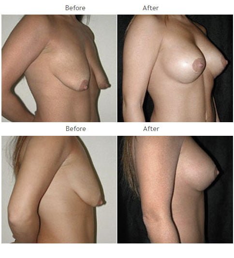 Breast augmentation before and after 36 Breast Augmentation NYC Case 1054