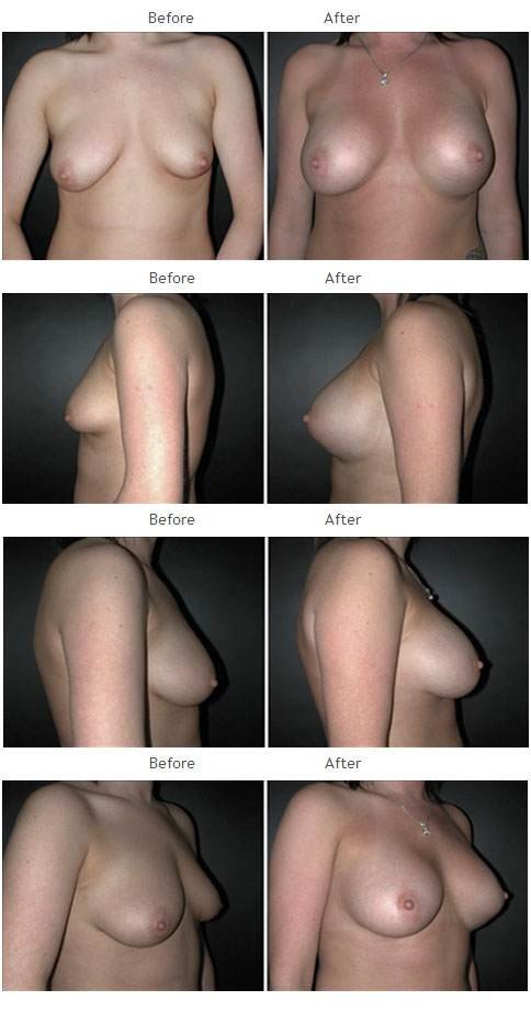 Breast augmentation before and after 37 Breast Augmentation NYC Case 1055