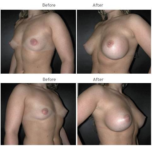 Breast augmentation before and after 38 Breast Augmentation NYC Case 1056