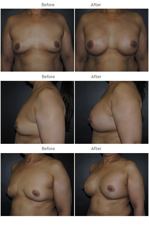 Breast augmentation before and after 40 Breast Augmentation NYC Case 1059
