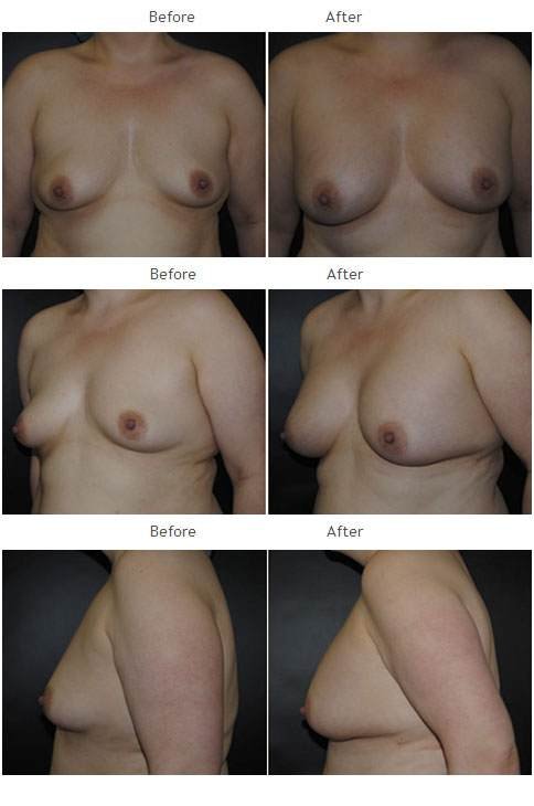 Breast augmentation before and after 42 Breast Augmentation NYC Case 1061