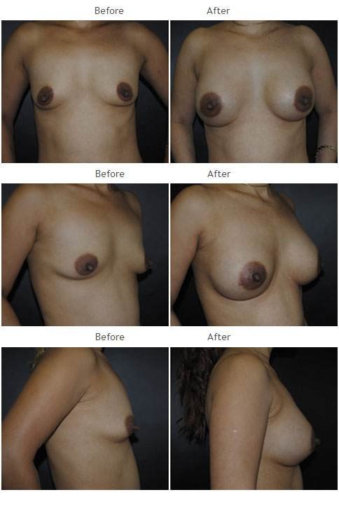 Breast augmentation before and after 43 Breast Augmentation NYC Case 1062