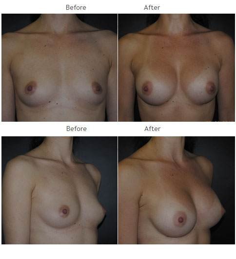 Breast augmentation before and after 44 Breast Augmentation NYC Case 1063