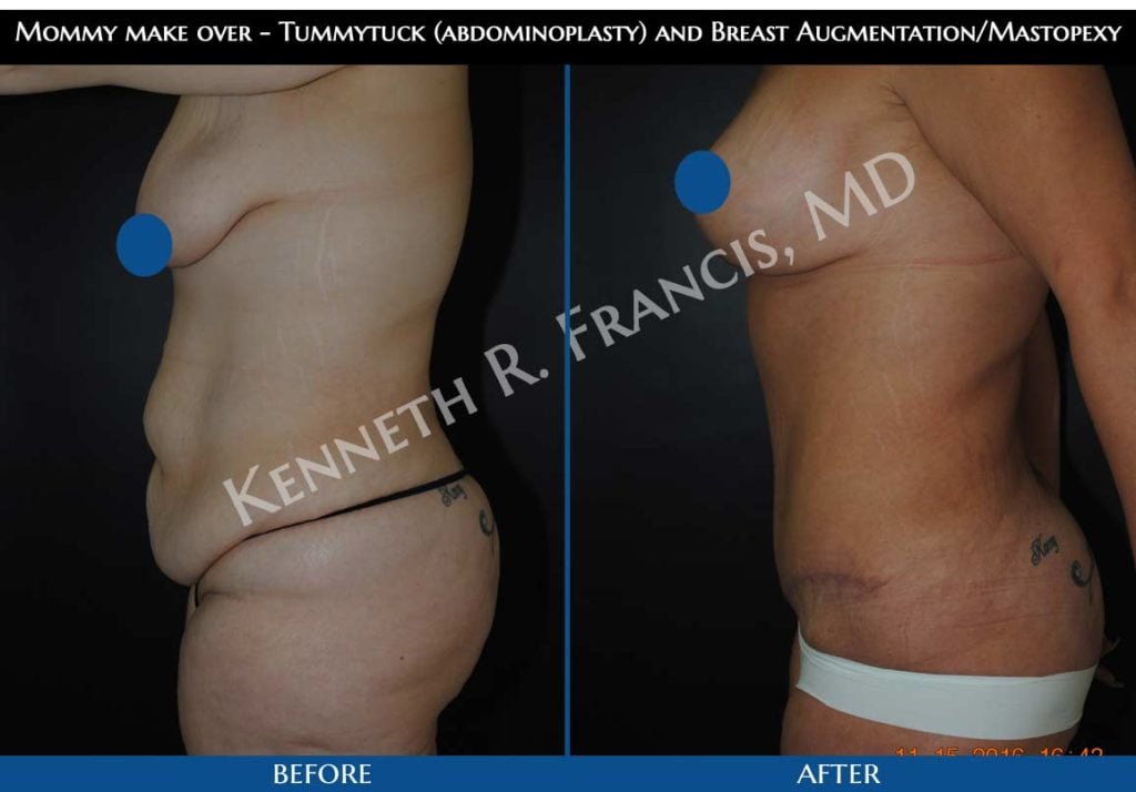 Breast augmentation before and after 25 Mommy make over - Tummytuck (abdominoplasty) and Breast Augmentation/Mastopexy