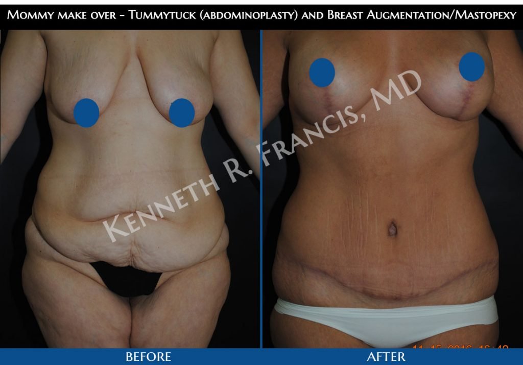 Breast augmentation before and after 24 Mommy make over - Tummytuck (abdominoplasty) and Breast Augmentation/Mastopexy