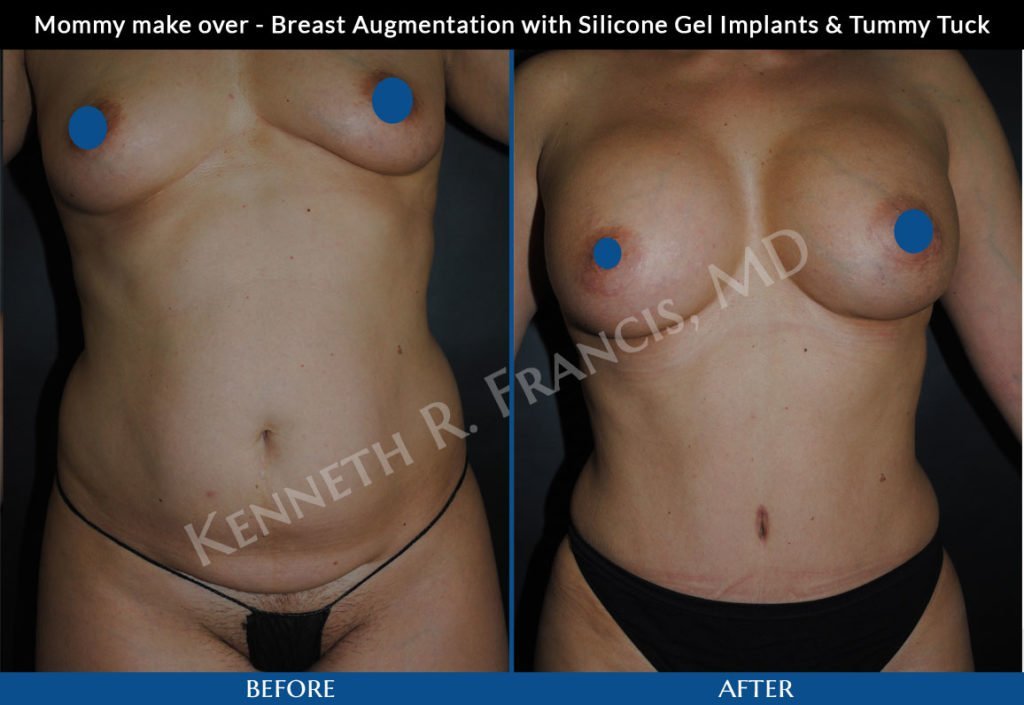 Breast augmentation before and after 22 Mommy make over - Breast Augmentation with Silicone Gel Implants & Tummy Tuck