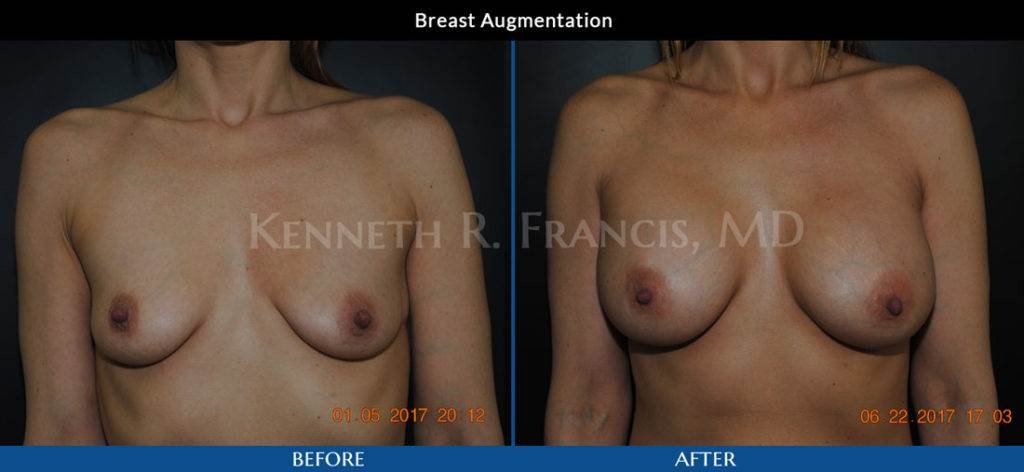 Breast augmentation before and after 21 breast augmentation before and after in Manhattan NYC