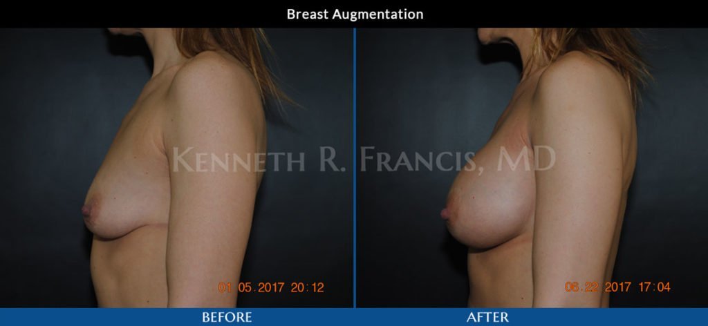 Breast augmentation before and after 20 breast augmentation before and after in Manhattan NYC