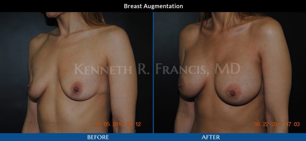 Breast augmentation before and after 19 breast augmentation before and after in Manhattan NYC