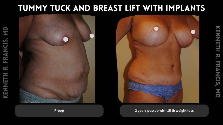 Breast augmentation before and after 5 Tummy tuck and breast lift with implants
