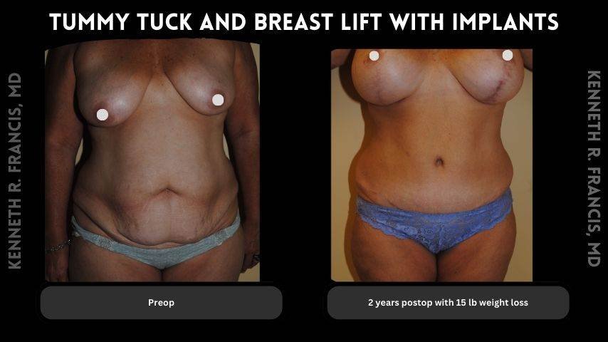 Breast augmentation before and after 4 Tummy tuck and breast lift with implants