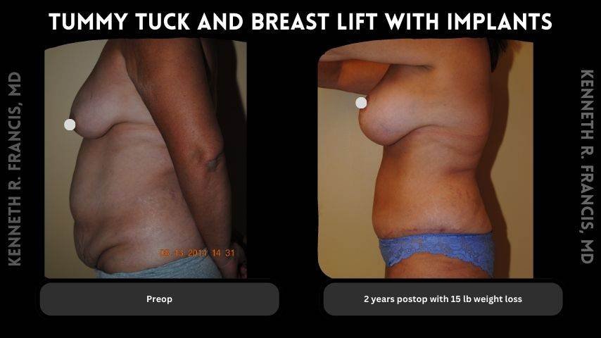 Breast augmentation before and after 3 Tummy tuck and breast lift with implants