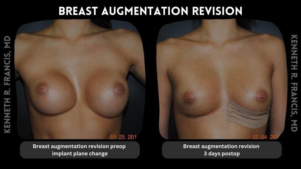 Breast augmentation before and after 1 Breast augmentation revision before and after
