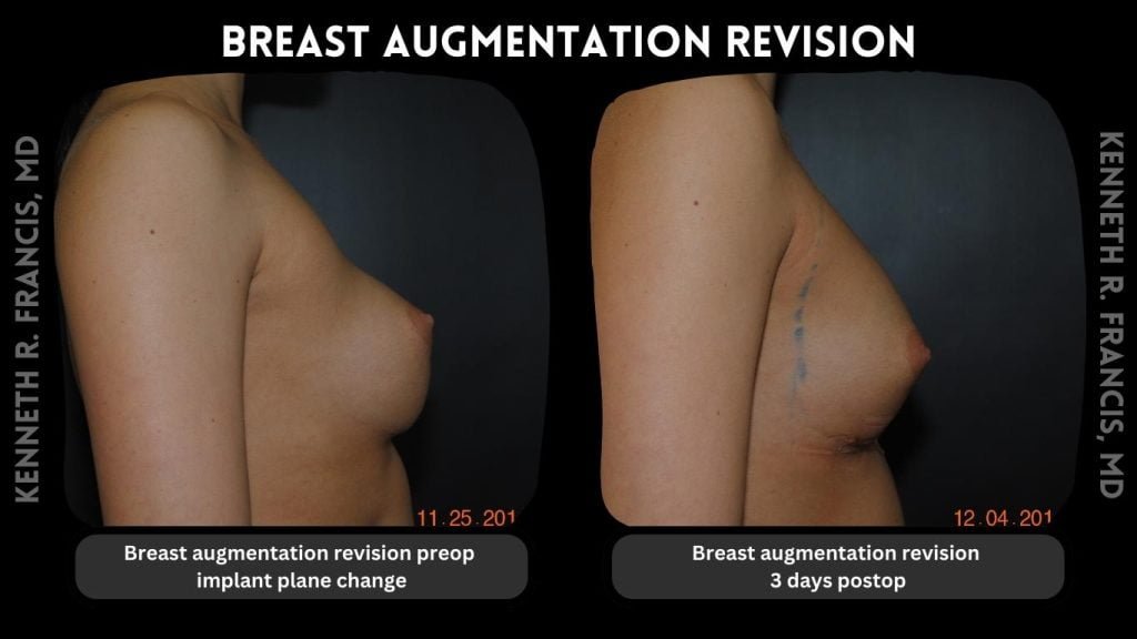 Breast augmentation before and after 2 Breast augmentation revision before and after